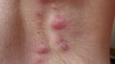 Photo of सबसे दर्दनाक त्वचा रोग हाइड्राडेनाइटिस सुपरेटिवा (HS): लक्षण और उपचार के विकल्प